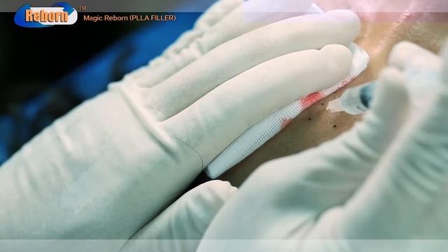 филлер полимолочной кислоты Reborn PLLA Filler