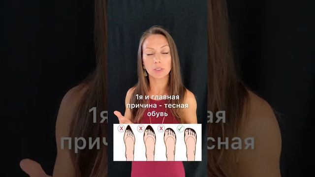 Как остановить деформацию большого пальца?(халюс вальгус)