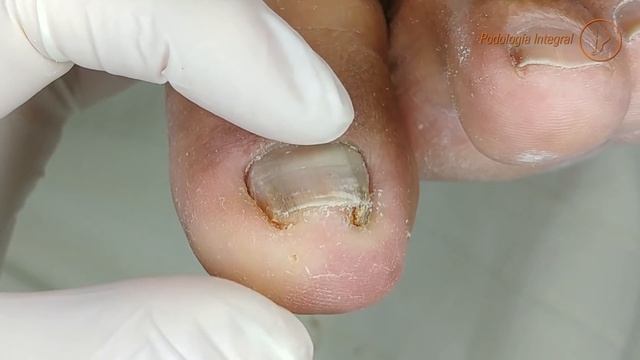 1 year later | Ingrown toenail & granuloma (3rd part) #podologiaintegral смотреть онлайн