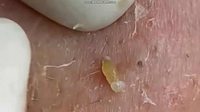 Черные точки Чистка лица смотреть онлайн