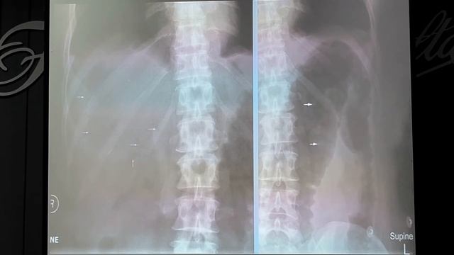 08 Головенко АВ Когда оперировать больного тяжелым язвенным колитом