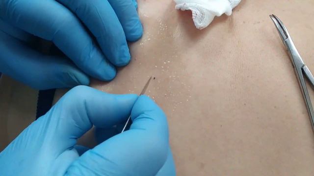 Атерома спины. Удаление. смотреть онлайн