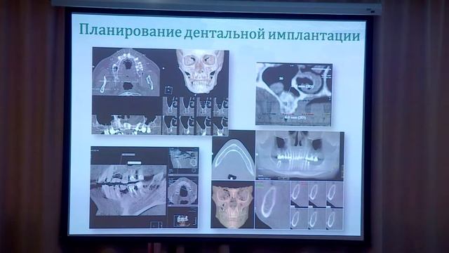 Петровская В.В. — Особенности конусно-лучевой КТ в решении задач ортопедической стоматологии смотреть онлайн