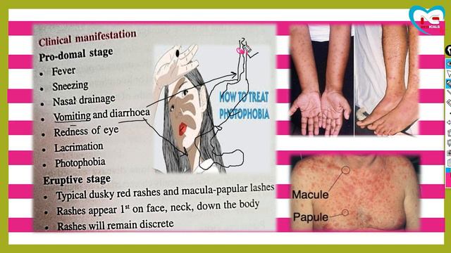 MEASLES-(WITH EASY NOTES)- | FULL EXPLANATION IN HINDI BY N.G MEDICALS смотреть онлайн