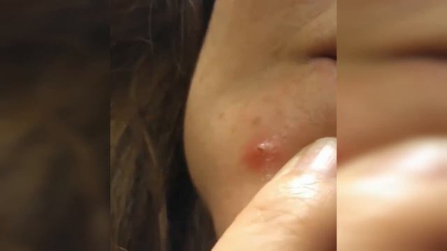 подборка выдавливания прыщей 23 II выдавливание прыщей