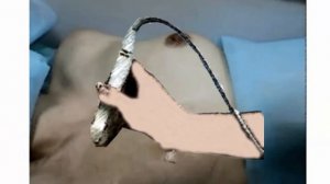 Как делают УЗИ молочной железы