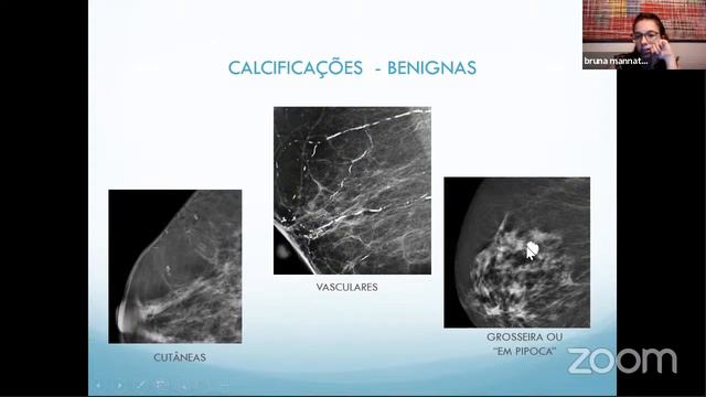 BI-RADS - IFMSA Brazil Santa Marcelina смотреть онлайн