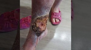 Рожа болезнь. Лечение Рожи.