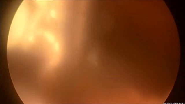 Удаление ВМС . Хирургическая гистероскопия. смотреть онлайн