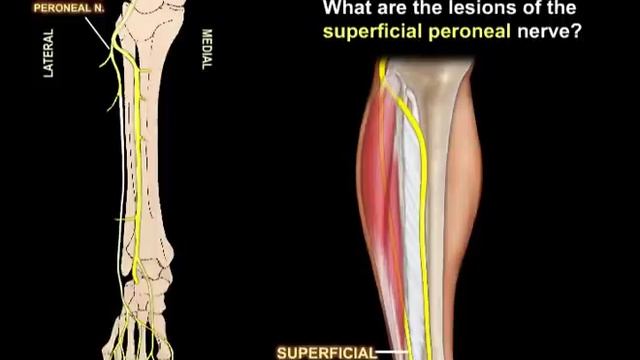 Lesions Of The Sciatic Nerve & Its Branches - Everything You Need To Know - Dr. Nabil Ebraheim смотреть онлайн