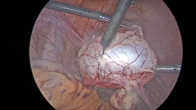 параовариальная киста