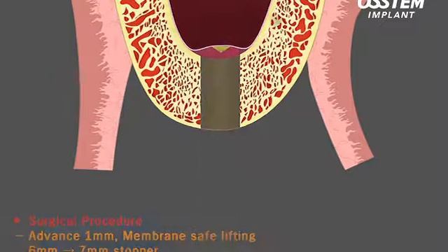 CAS KIT - Crestaler Sinus-Lift - OSSTEM смотреть онлайн