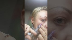 Мезотерапия препаратом гиалуроновой кислоты.