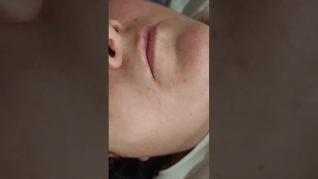 Удаление волос на подбородке и в зоне усиков ? смотреть онлайн