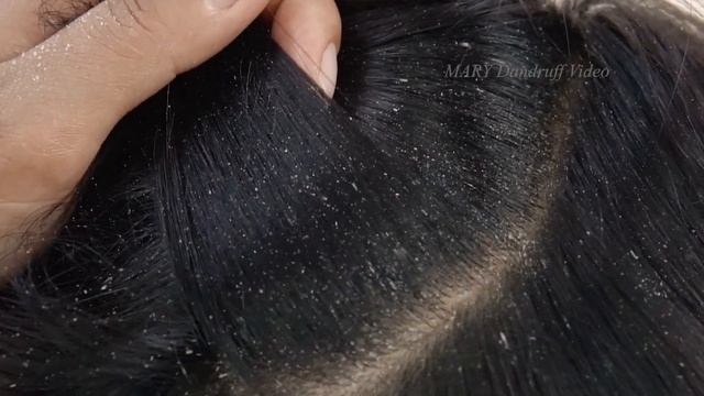 Удаление огромных чешуек перхоти #906