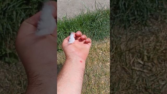 Что делать при укусе лосиной мухи. Последствия укуса смотреть онлайн