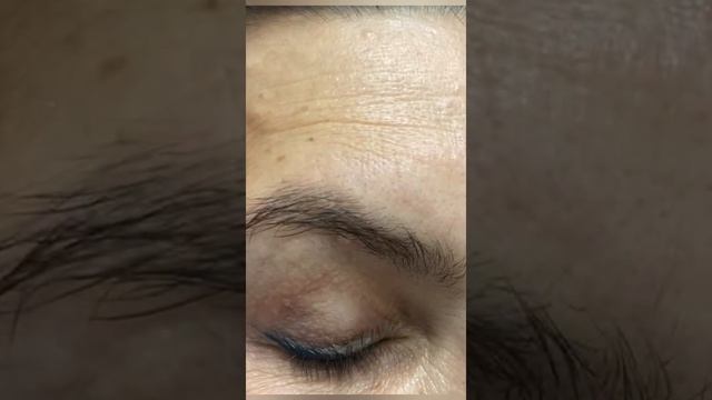круговая блефаропластика и подтяжка лица смотреть онлайн