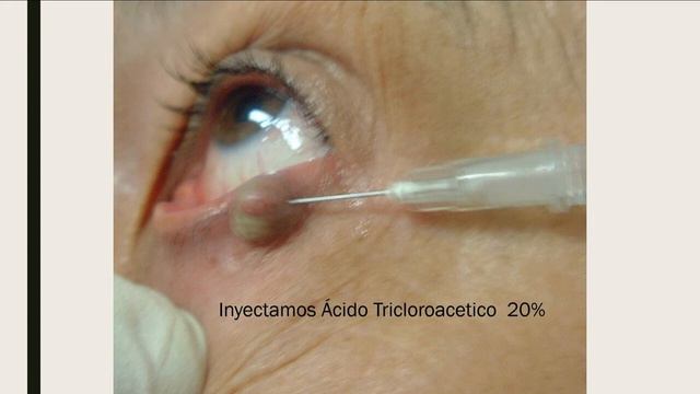 46 Dr Mauro Rivas y Dr Nelson Manon Manejo Hidrocistomas palpebrales con Acido Tricloroacético смотреть онлайн