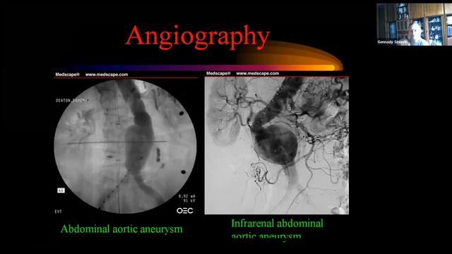 Lection: Aortic aneurysm смотреть онлайн