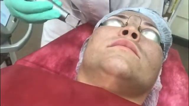 Карбоновый (голливудский) пилинг смотреть онлайн