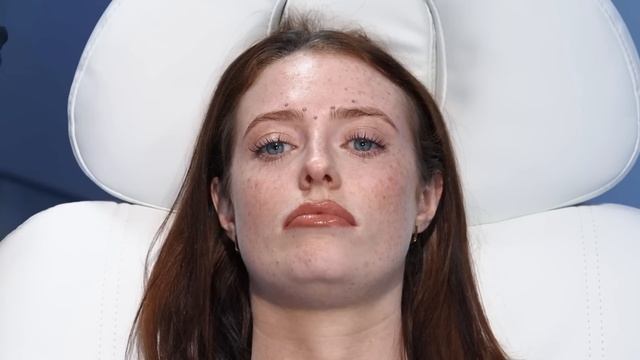 Botox Brow Lift Injection Patterns. Botox Mark-Up Tutorial смотреть онлайн