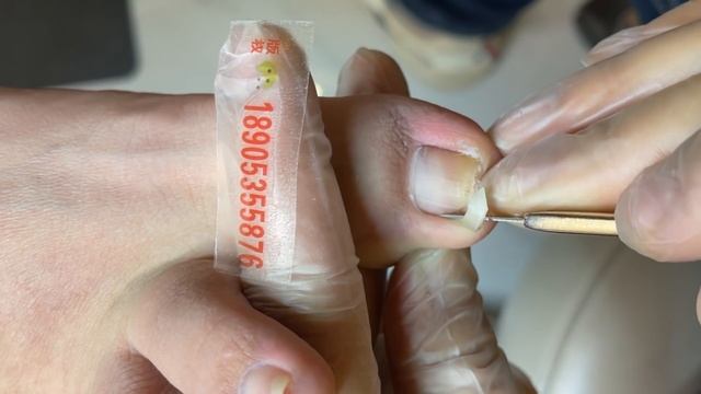 Fungus Nail Treatment