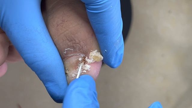 Pedicure Tutorial Inflammation On Both Sides Of Toenails 【Pedicure Master Lin Jun】