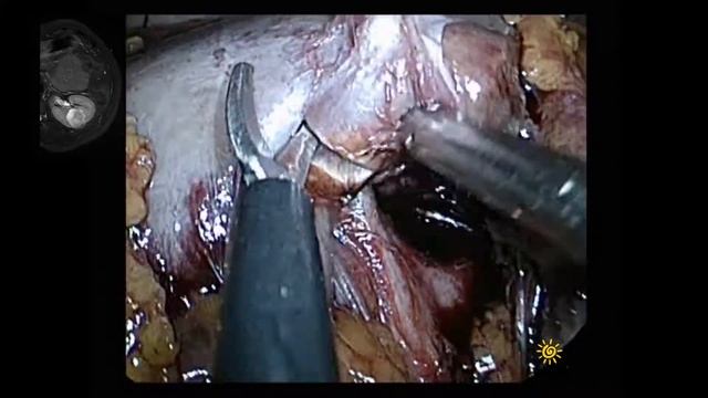 Endophytic renal tumor partial nephrectomy/резекция почки в синусе / интрасинусная смотреть онлайн