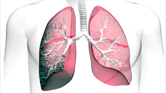 Как вылечить эмфизему легких в домашних условиях Симптомы эмфиземы легких Как лечили эмфизему в ССС смотреть онлайн