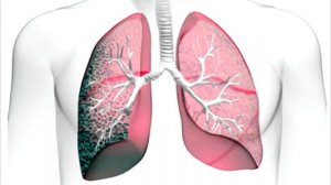 Как вылечить эмфизему легких в домашних условиях Симптомы эмфиземы легких Как лечили эмфизему в ССС