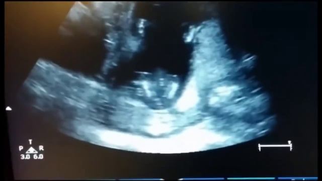 ребенок хлопает ручками в утробе матери смотреть онлайн