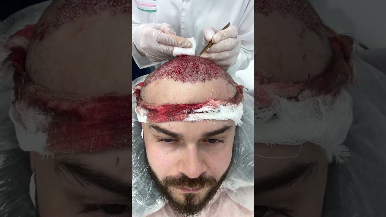 Клиника «ОгузМед»Для записи на пересадку волос : +7 (904) 604-85-70 (What’s App)