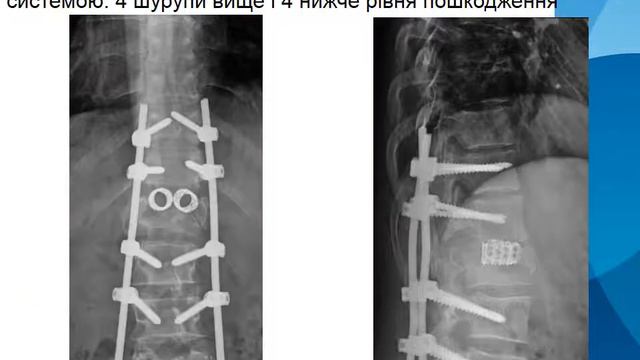 Лікування травматичних пошкоджень грудного та поперекового відділів хребта смотреть онлайн
