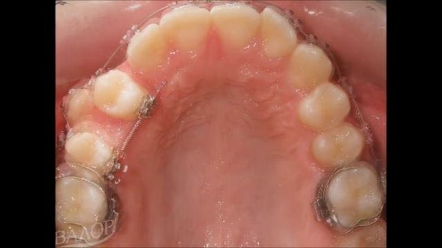 13-годишна пациентка с транспозиция