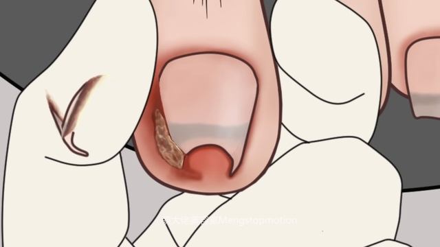 ASMR Ingrown Toenail Removal Treatment Animation~Strong Satisfaction!  | Meng's Stop Motion