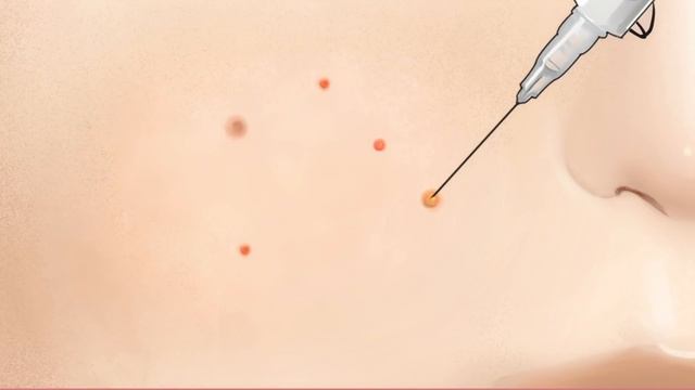 [AnimationASMR]Incharge Of Acne Extrusion,New Handsome Manager!│HwaniMarco Undercover│Acne Skin Car