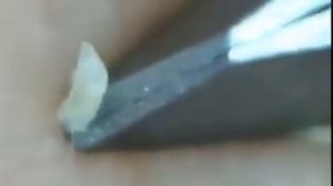Удаление пинцетом черных точек на носу/Squeezing blackheads
