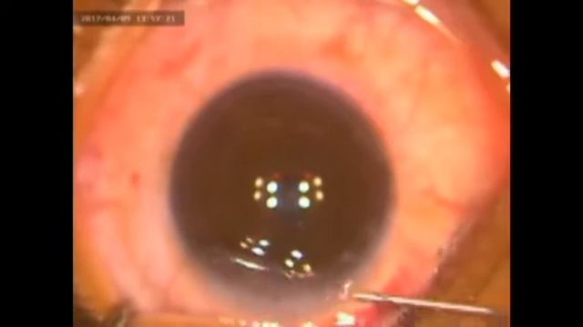 Femto Lasik & Lasik Xtra (LASIK and cross-linking) смотреть онлайн