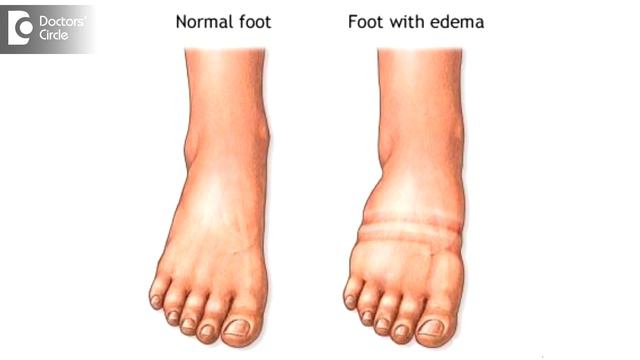 Possible causes for swelling in legs - Dr. Sharat Honnatti смотреть онлайн