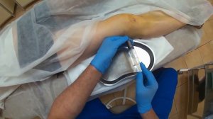 | Доктор Хисомов делится навыками | Пункция коленного сустава при гемартрозе