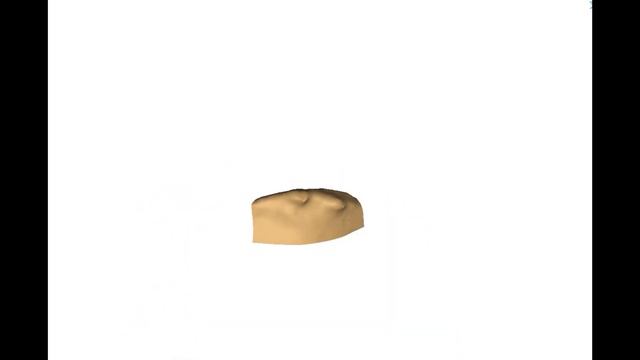 Jaw Reconstruction Surgery | 3D-printed Titanium Implant смотреть онлайн