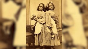 Сестры МакКой - сиамские близнецы