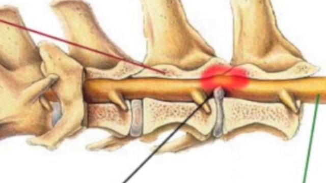 Herniation смотреть онлайн
