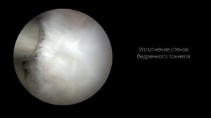 Пластика ПКС. Только кортикальная фиксация.