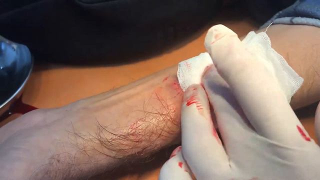 КЕРАТОАКАНТОМА смотреть онлайн