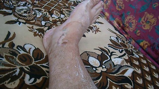 Сняли гипс на ноге после перелома лодыжки смотреть онлайн