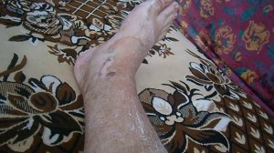 Сняли   гипс    на   ноге  после перелома  лодыжки