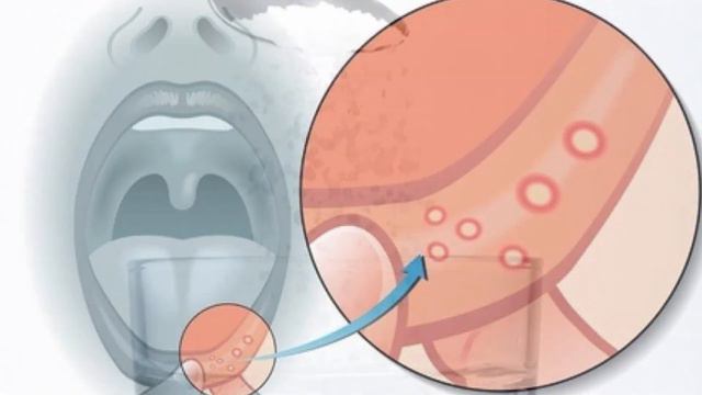 Этот простой ТРЮК поможет ИЗБАВИТЬСЯ ОТ СТОМАТИТА с помощью соли и лимона! смотреть онлайн