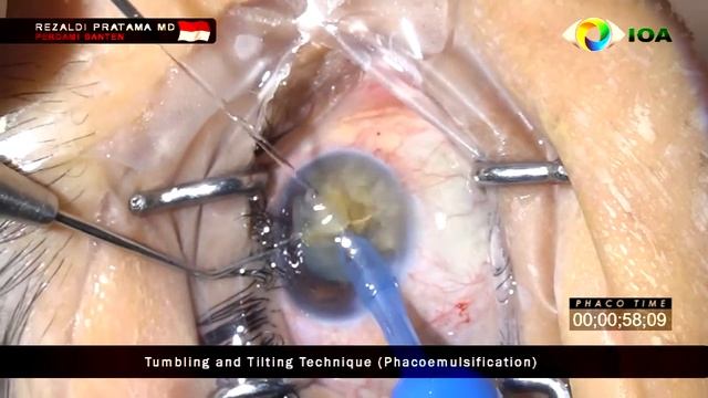 Hard Cataract - Phaco by Aldi MD 6060* смотреть онлайн