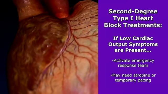 AV Heart Blocks EKG Interpretation Made Easy (1st, 2nd, 3rd-Degree Comprehensive Review) смотреть онлайн